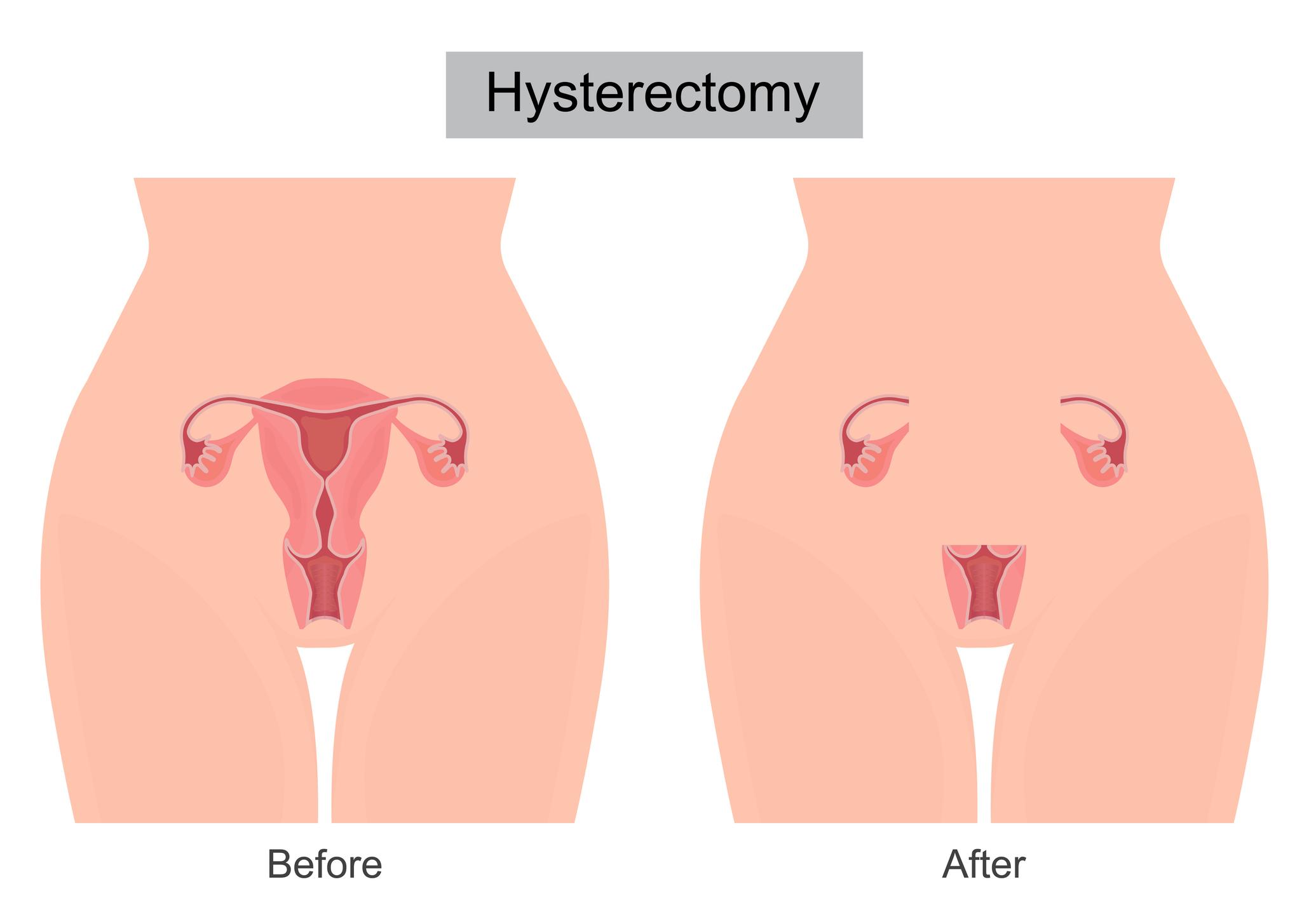 Laparoscopic Hysterectomy Specialist in Pune – Safe & Minimally Invasive Surgery